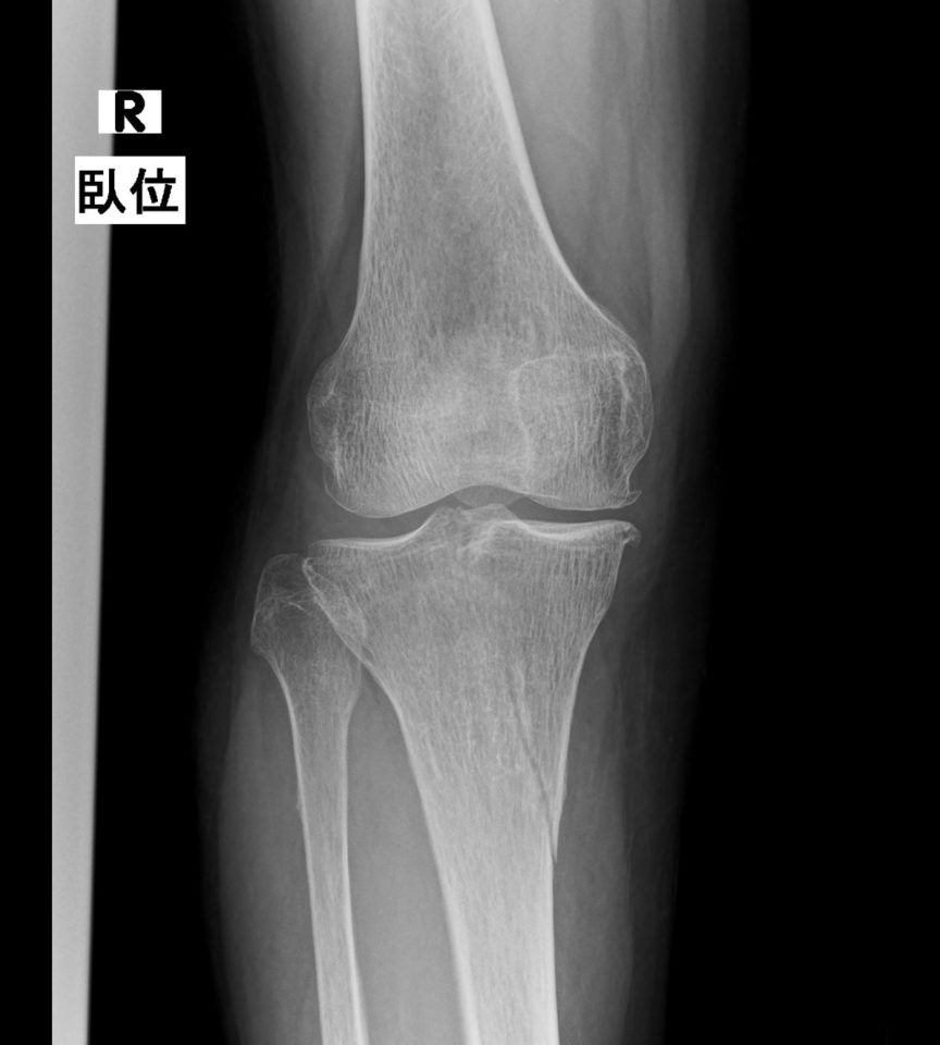 膝のレントゲン画像からわかる変形性膝関節症のKL分類について - 足立慶友整形外科