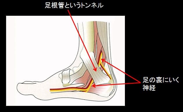 くるぶしから足裏のしびれ 足根菅症候群について 足立慶友整形外科