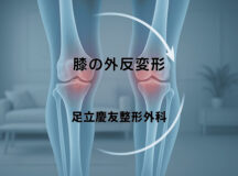 膝の外反変形｜原因から治療法まで