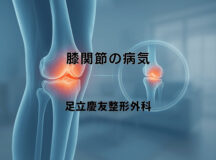 膝関節の病気｜症状による種類と治療法の違い