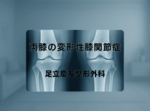 両膝の変形性膝関節症｜症状と治療の特徴