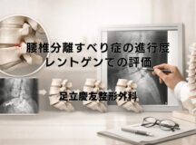 腰椎分離すべり症の進行度｜レントゲンでの評価