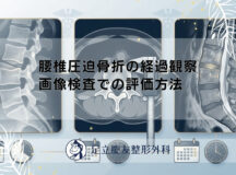 腰椎圧迫骨折の経過観察｜画像検査での評価方法