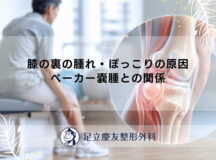 膝の裏の腫れ・ぽっこりの原因｜ベーカー嚢腫との関係