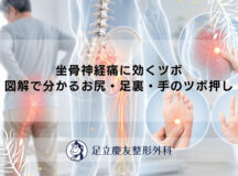 坐骨神経痛に効くツボ｜図解で分かるお尻・足裏・手のツボ押し